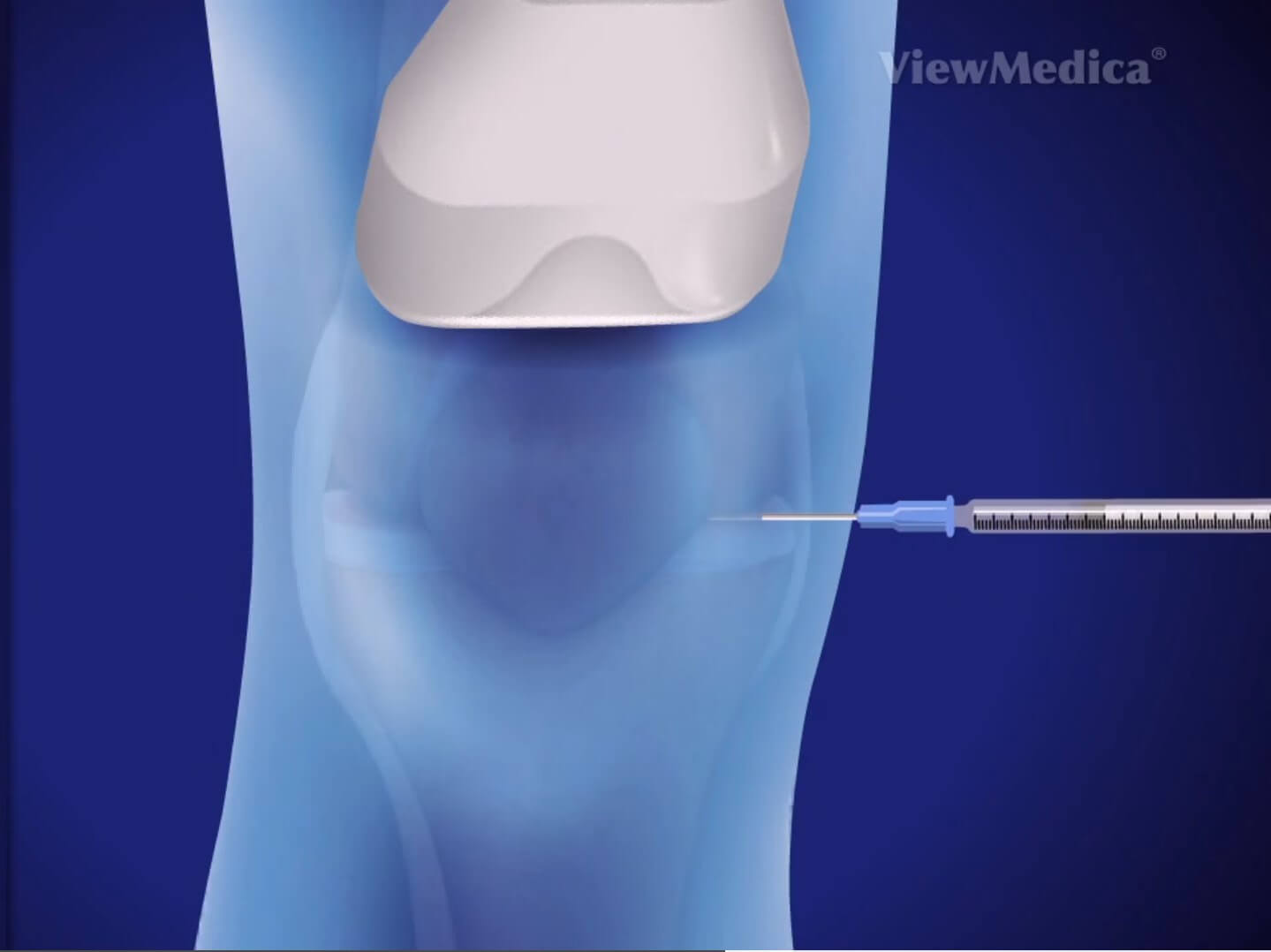 Viscosupplementation Treatment for Knee Arthritis